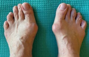 Hallux Valgus - Cours et stages-Yoga-Marseille 5è-Yvette Clouet